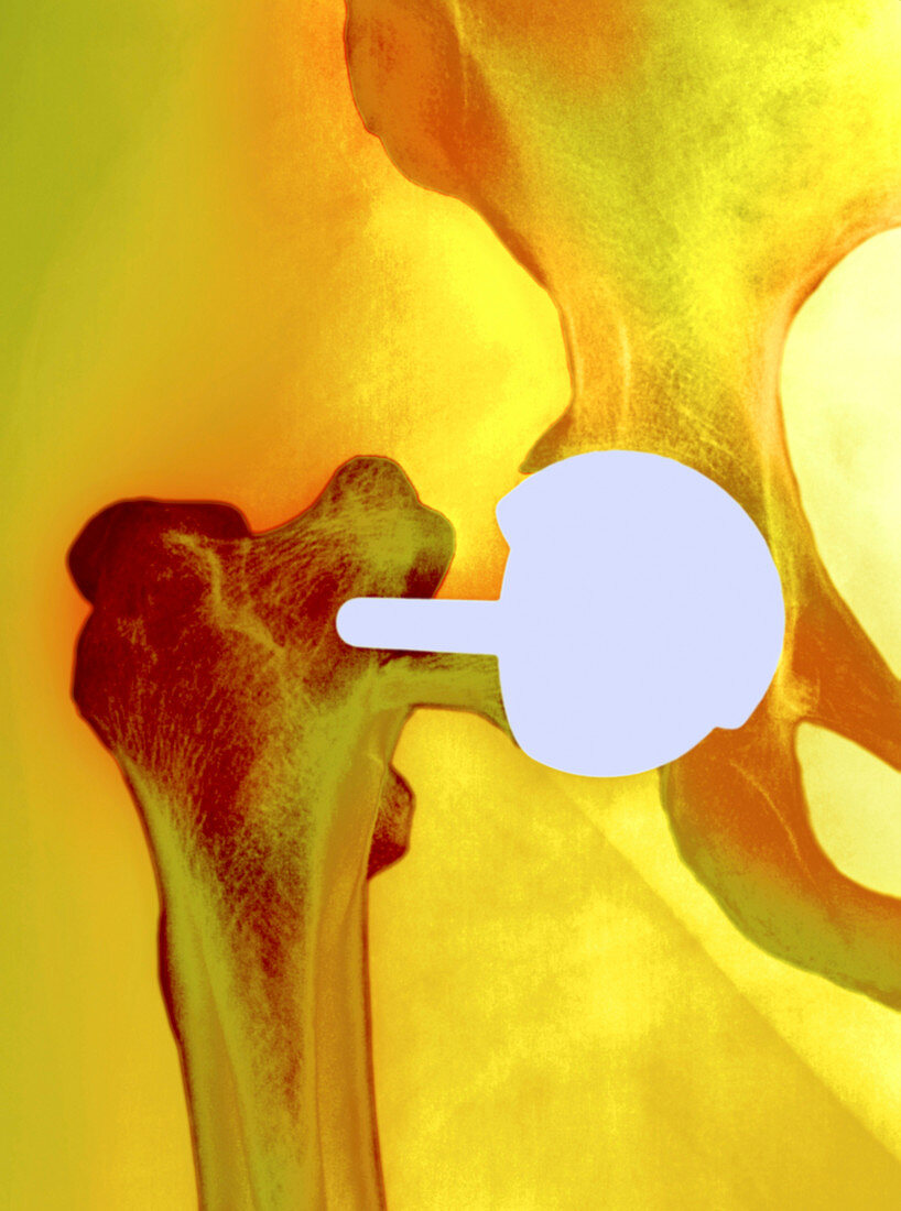 Failed hip resurfacing,X-ray