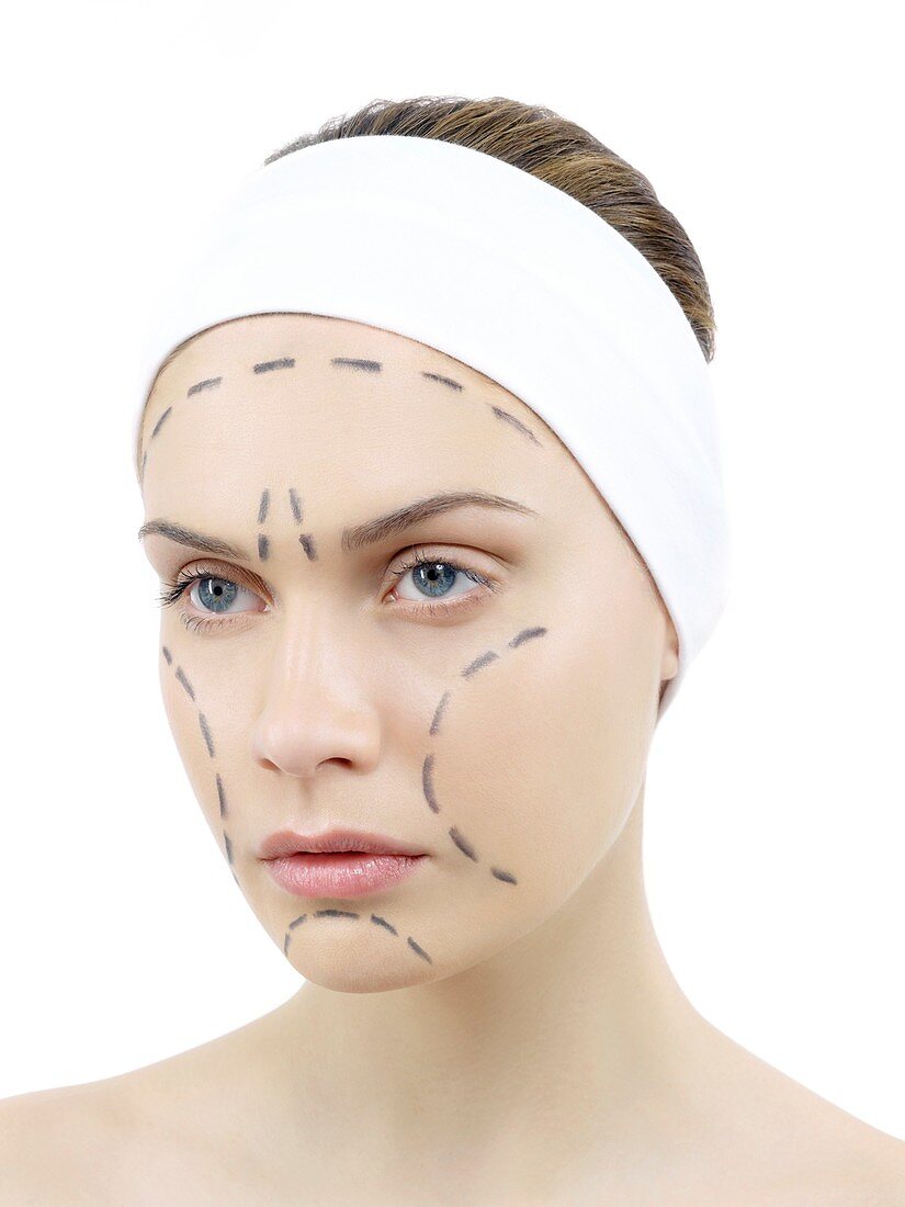 Facelift surgery markings