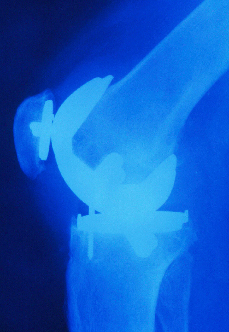 X-ray of prostheric knee joint