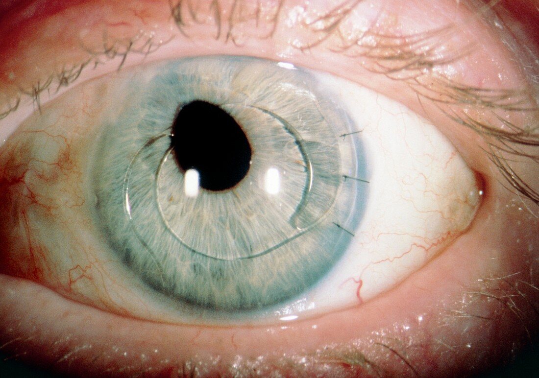 Artificial eye lens in situ