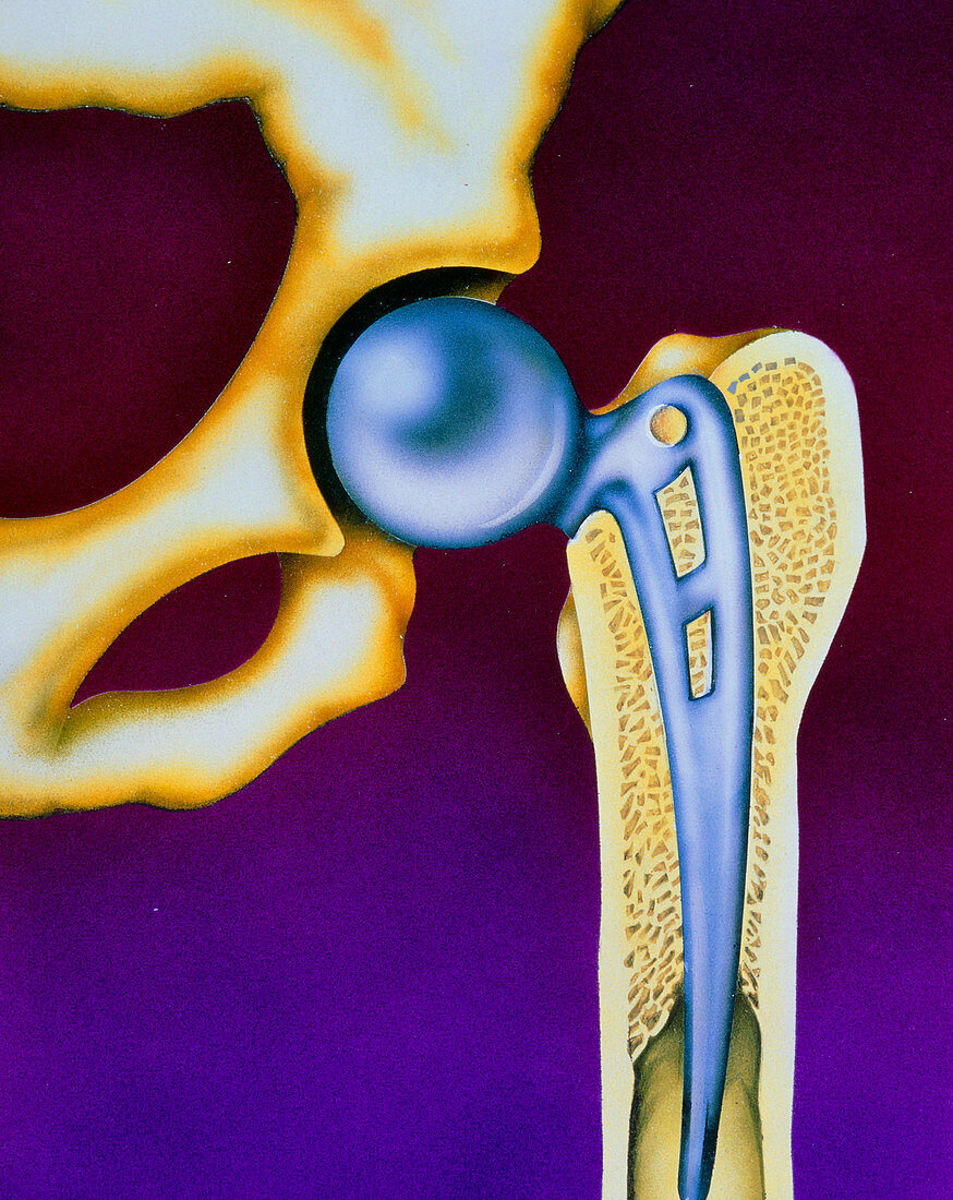 Illustration of a prosthetic hip joint