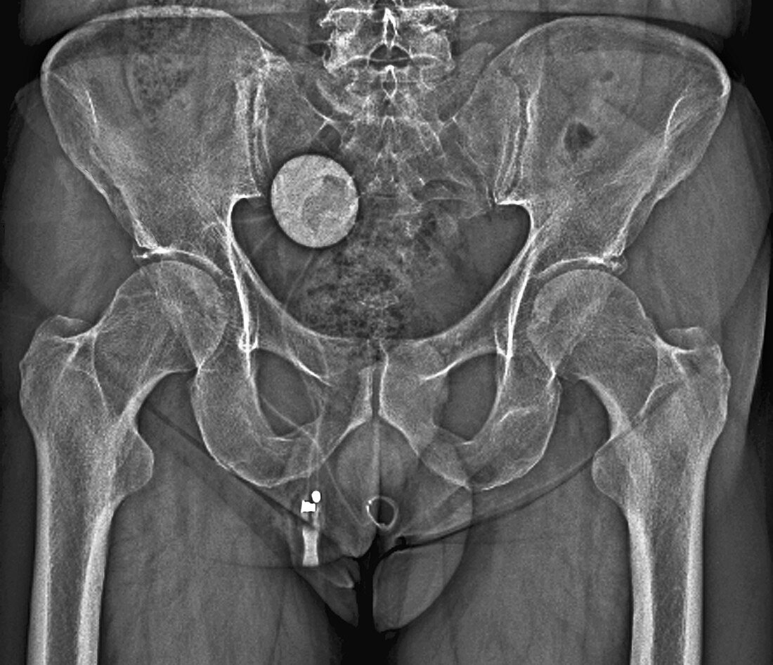 Artificial urinary sphincter,X-ray