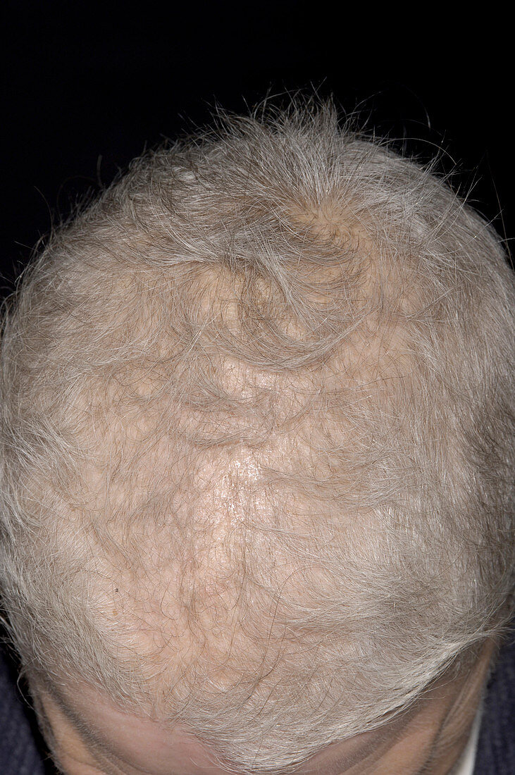 Hair regrowth after chemotherapy