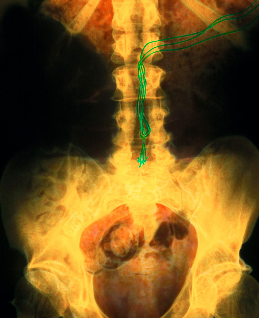 Coloured X-ray of a spinal column nerve stimulator