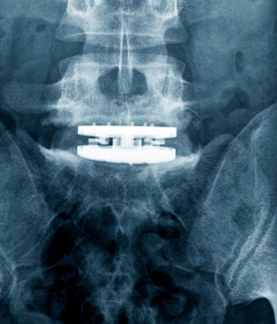 Intervertebral bone implant, X-ray