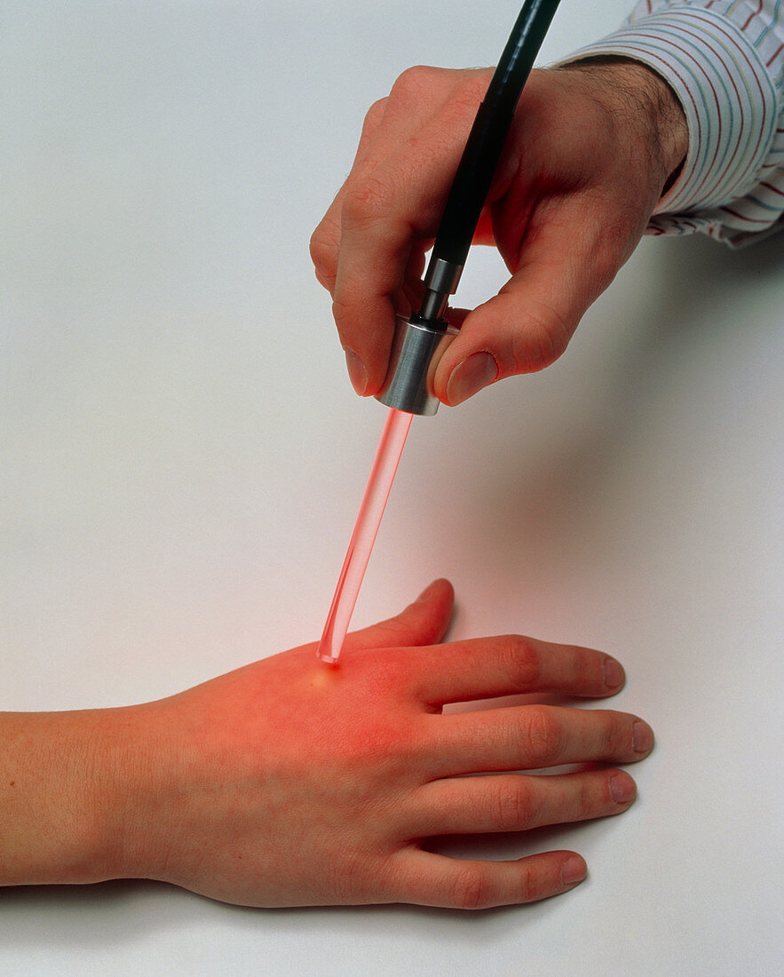 Paterson lamp used to treat skin cancer on a hand