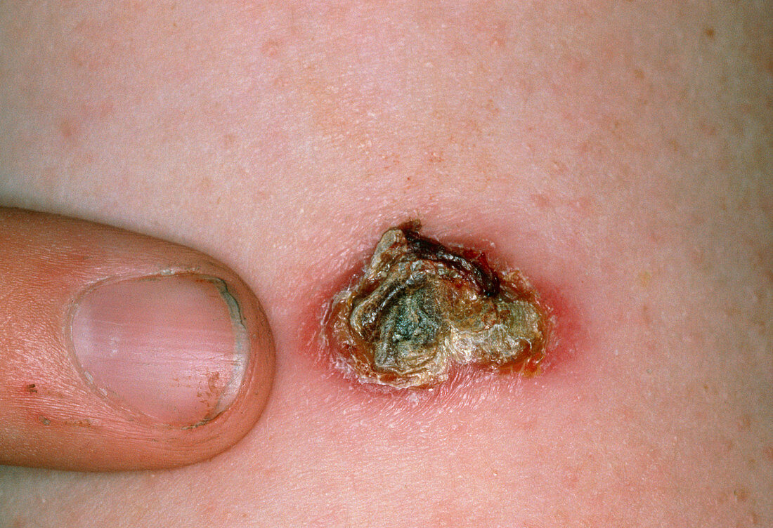 Close-up of severe reaction to TB vaccine