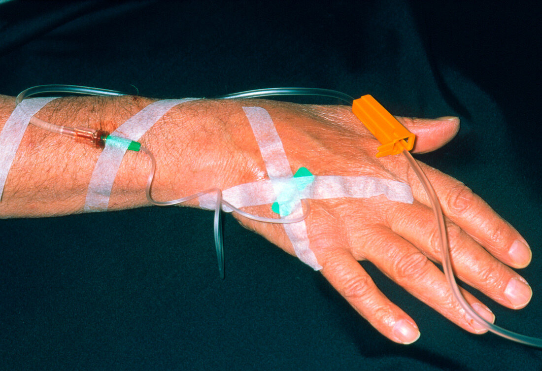 Man's forearm receiving immunoglobulin infusion