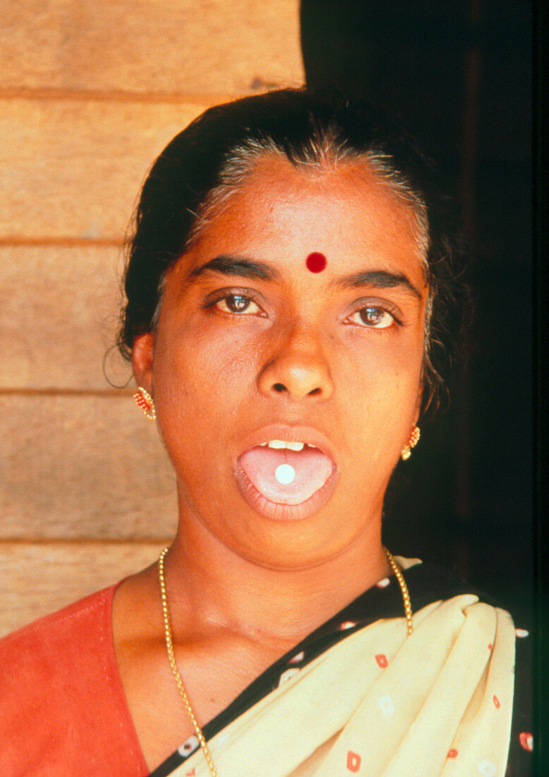 Indian woman with anti-filariasis pill on tongue