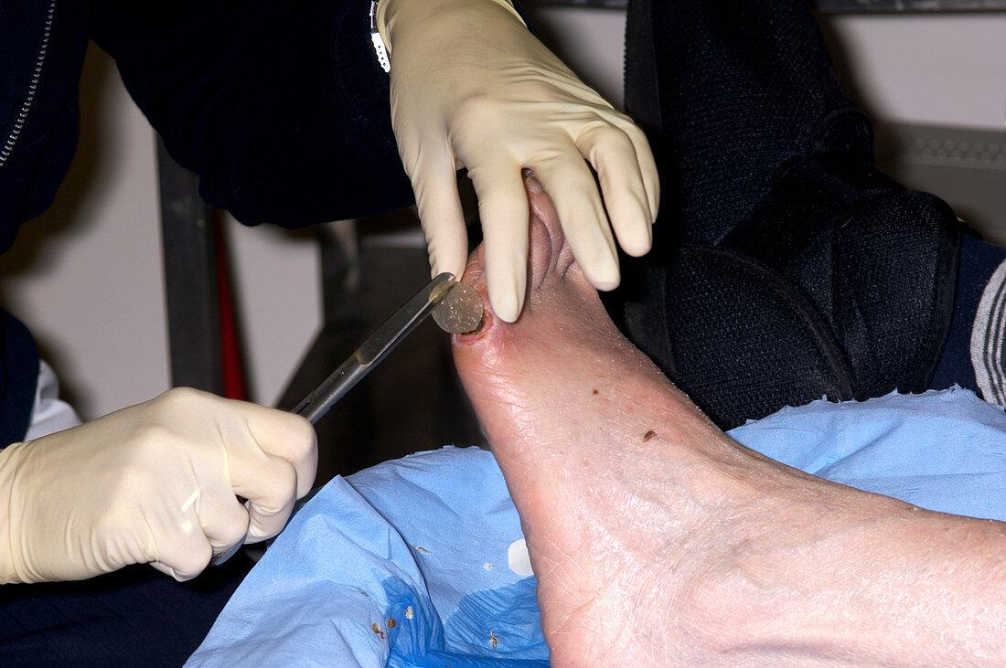 Chiropodist dressing a foot ulcer
