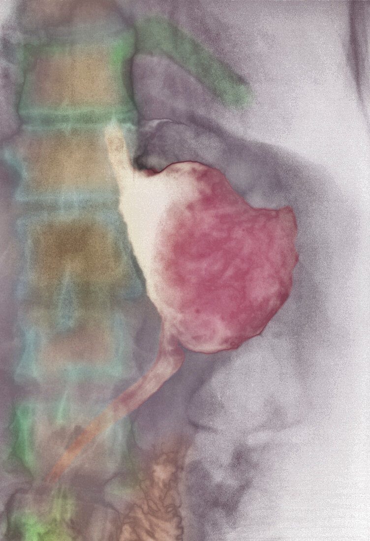 Stomach cancer treatment,X-ray