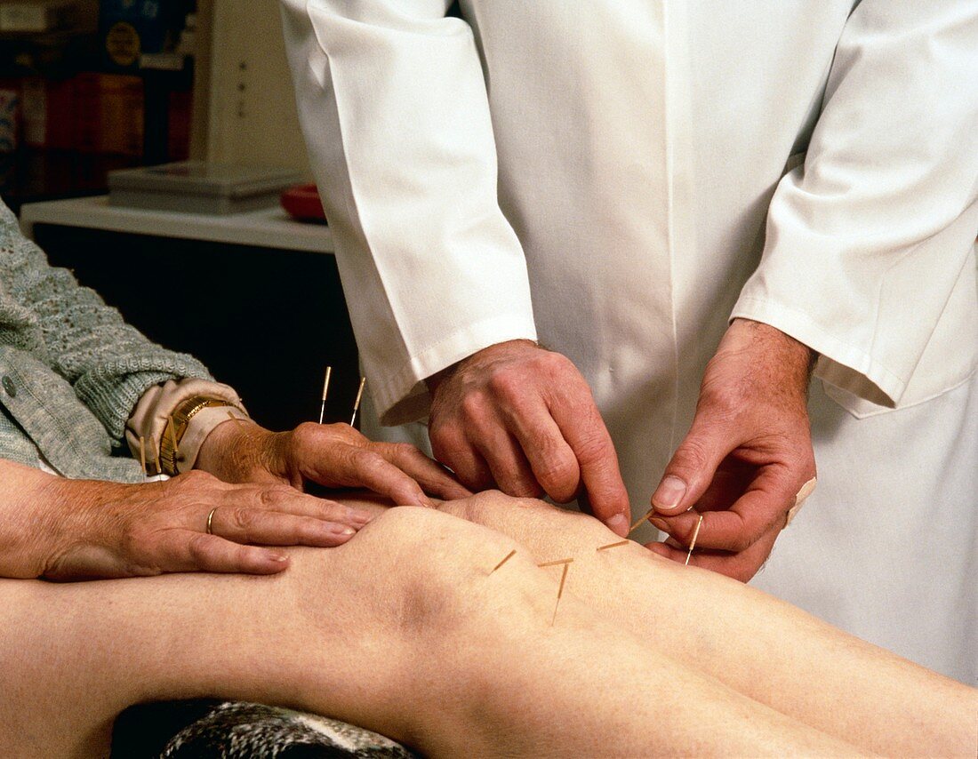 Acupuncturist applying needles for arthritis