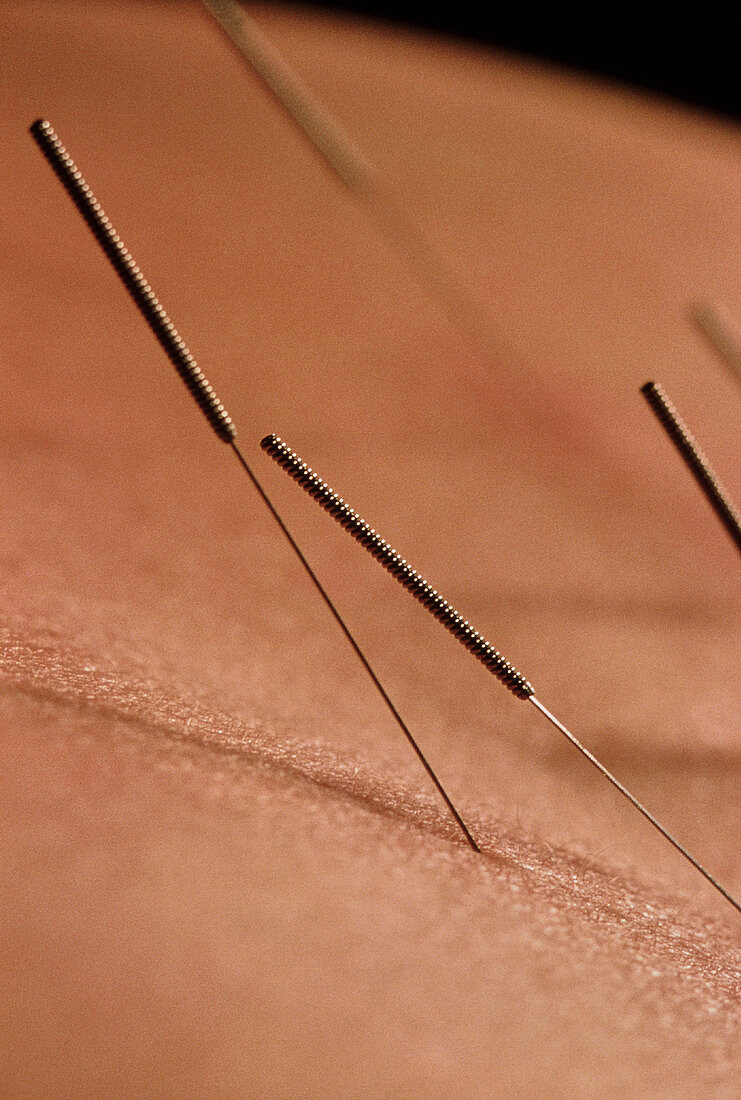 Close-up of acupuncture needles in skin