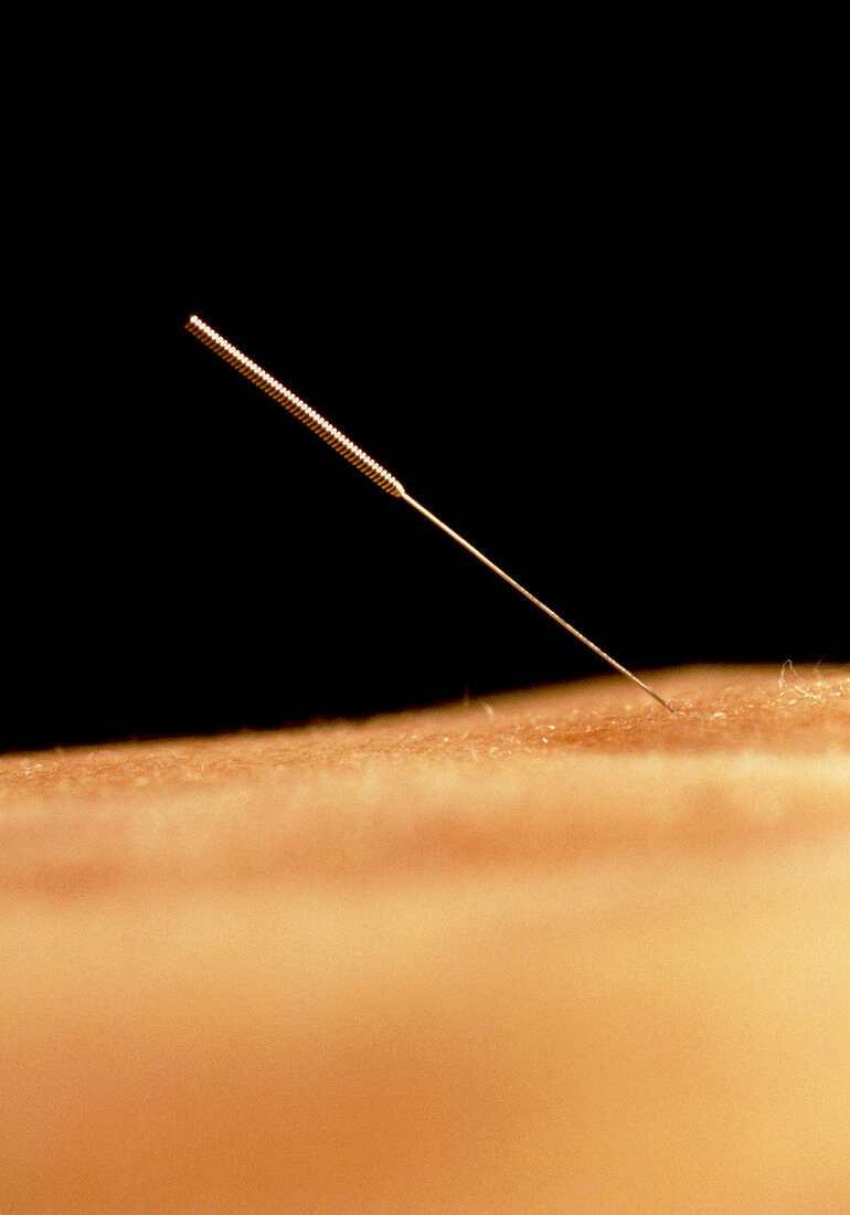 Acupuncture to reduce aggressive energy