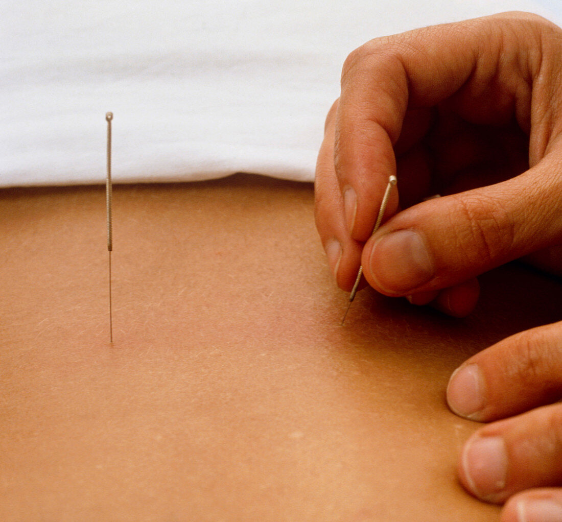 Acupuncturist manipulating needles on lower back