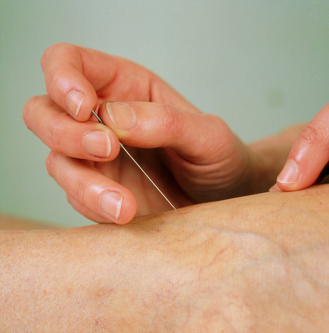 Acupuncture to the foot