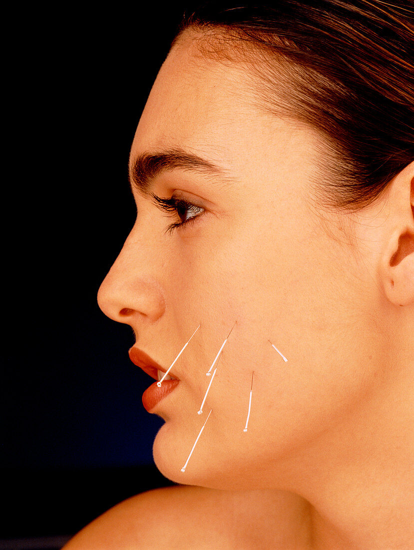 Woman with acupuncture needles in cheek