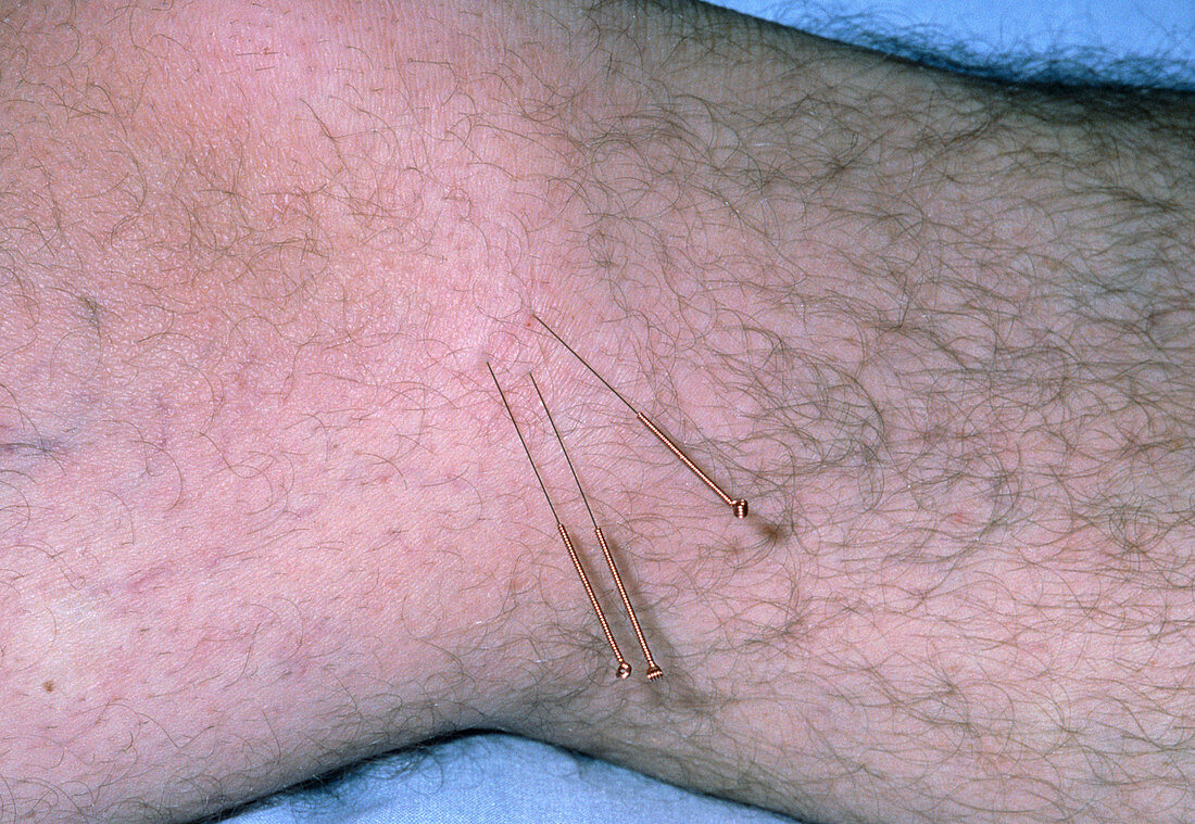 Acupuncture needles in a patient's knee