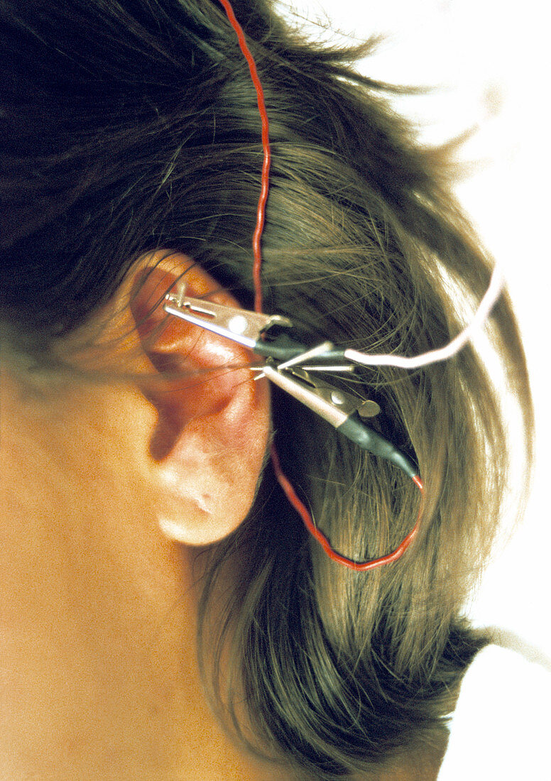 Ear electro-acupuncture