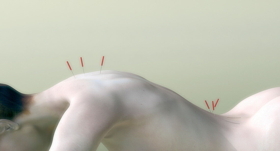 Acupuncture on woman's back,artwork