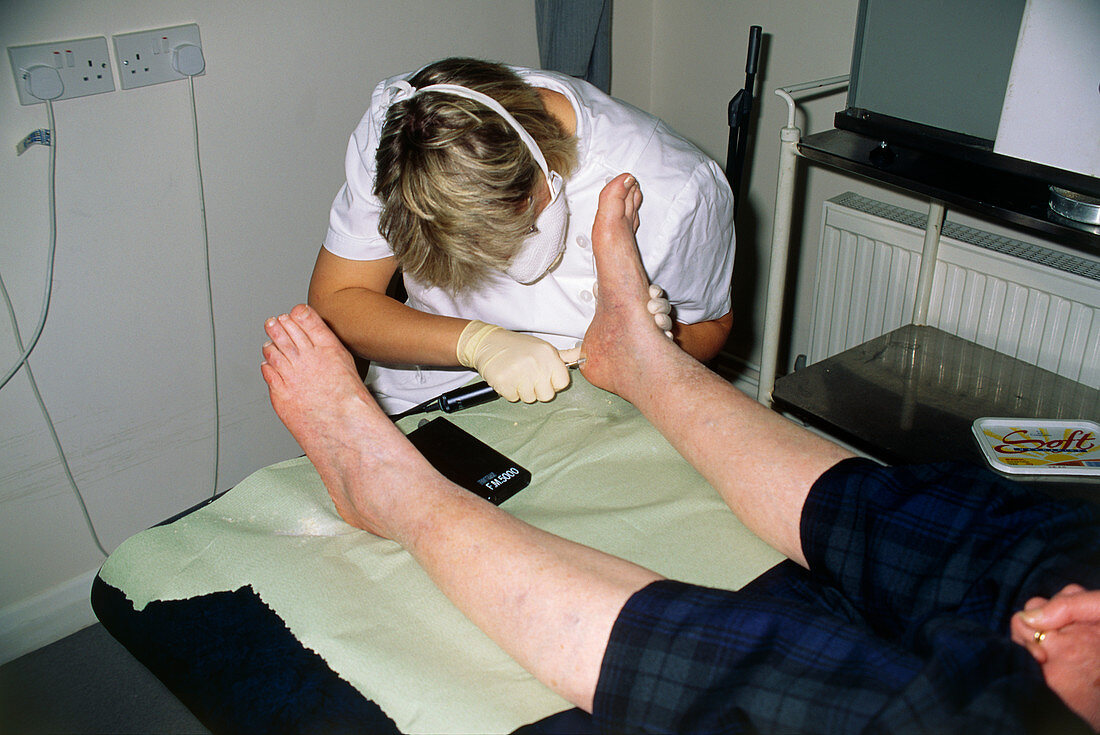 Chiropodist files calluses from patient's foot