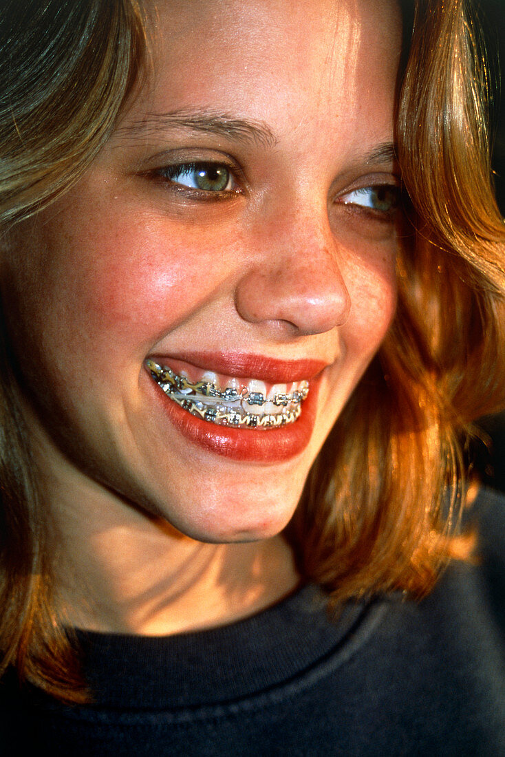 View of a girl with fixed braces on her teeth