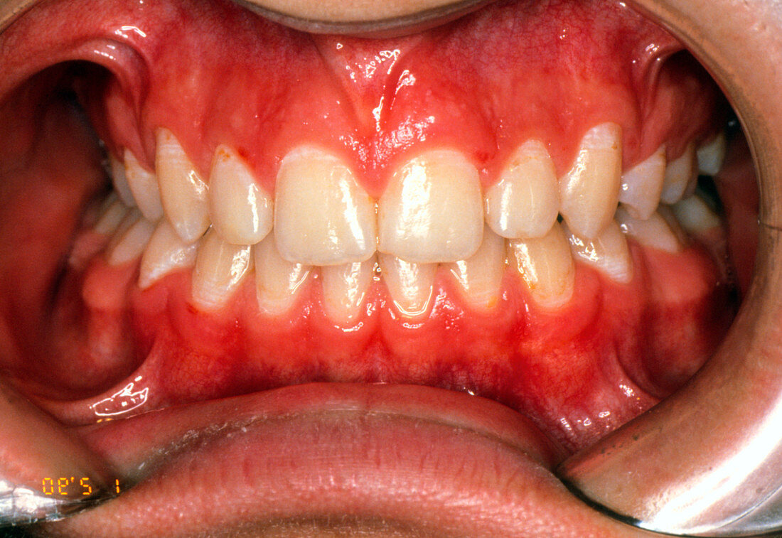 View of teeth after treatment with dental braces