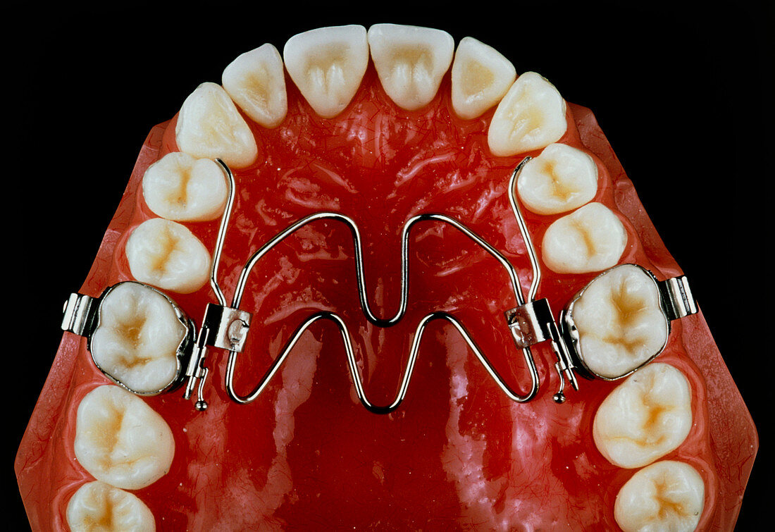 Shape memory metal dental brace on a model jaw