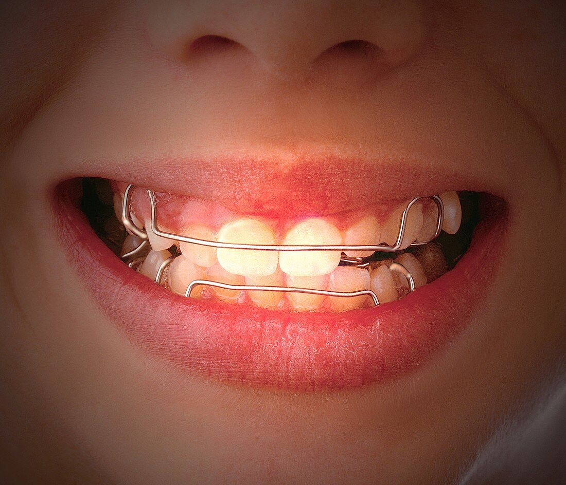 Removable orthodontic braces