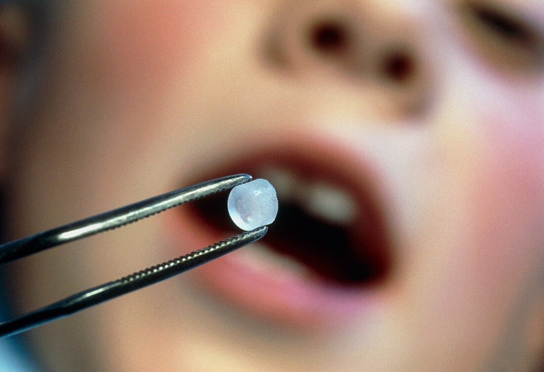 Child having a fluoride tooth implant fitted