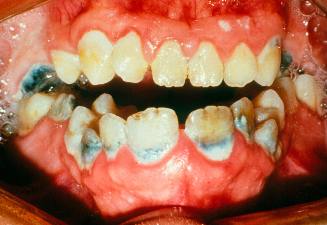 Unhealthy teeth and gums