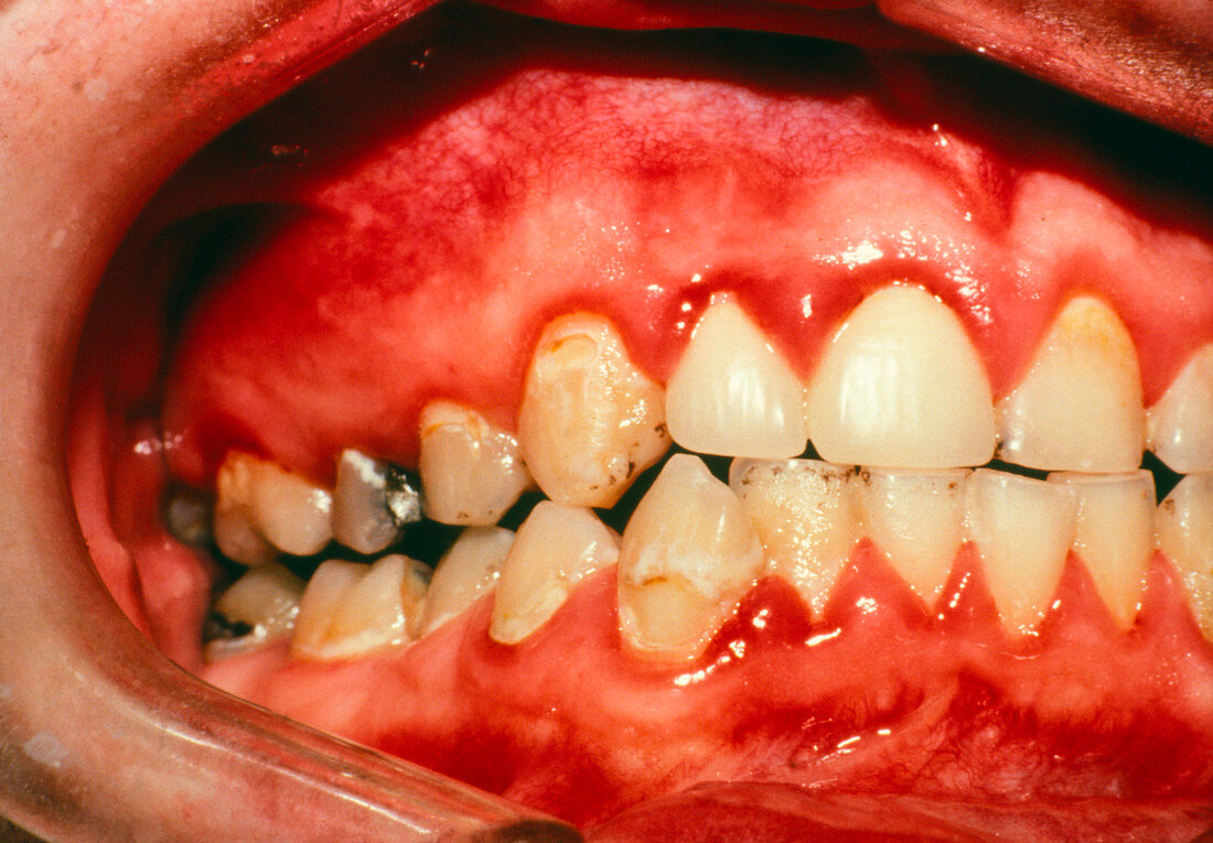 Close-up of teeth and gums showing gingivitis
