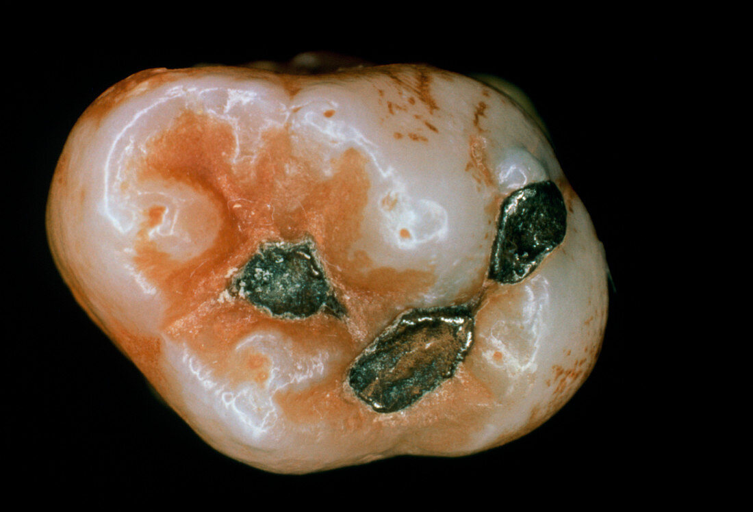 Extracted molar showing 3 amalgam fillings