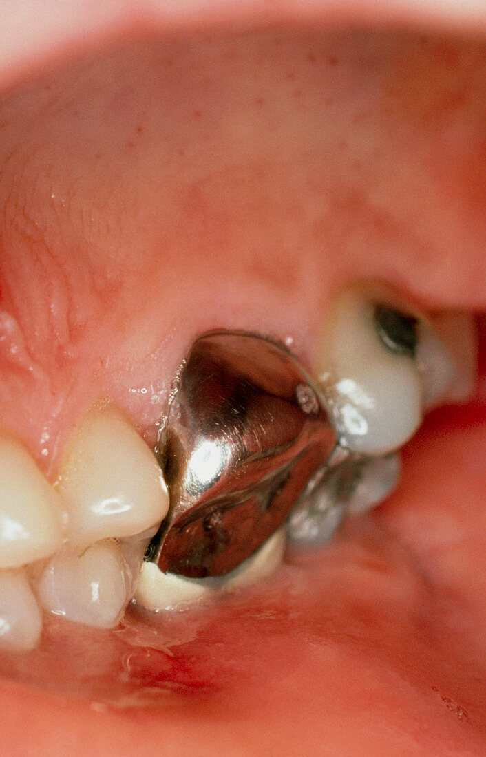 Metal crown fitted on an upper molar of 30 yr old