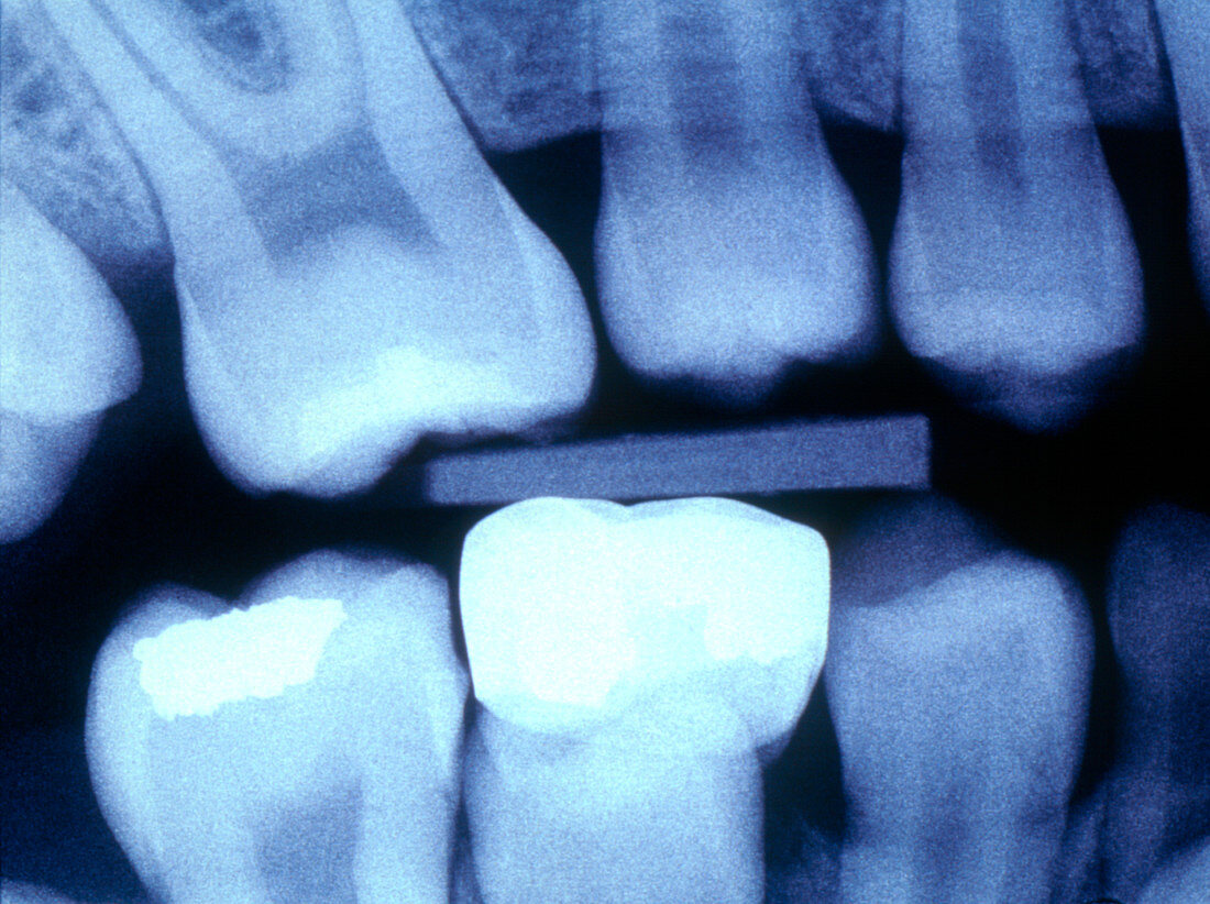 X-ray of child's teeth with fillings and a crown