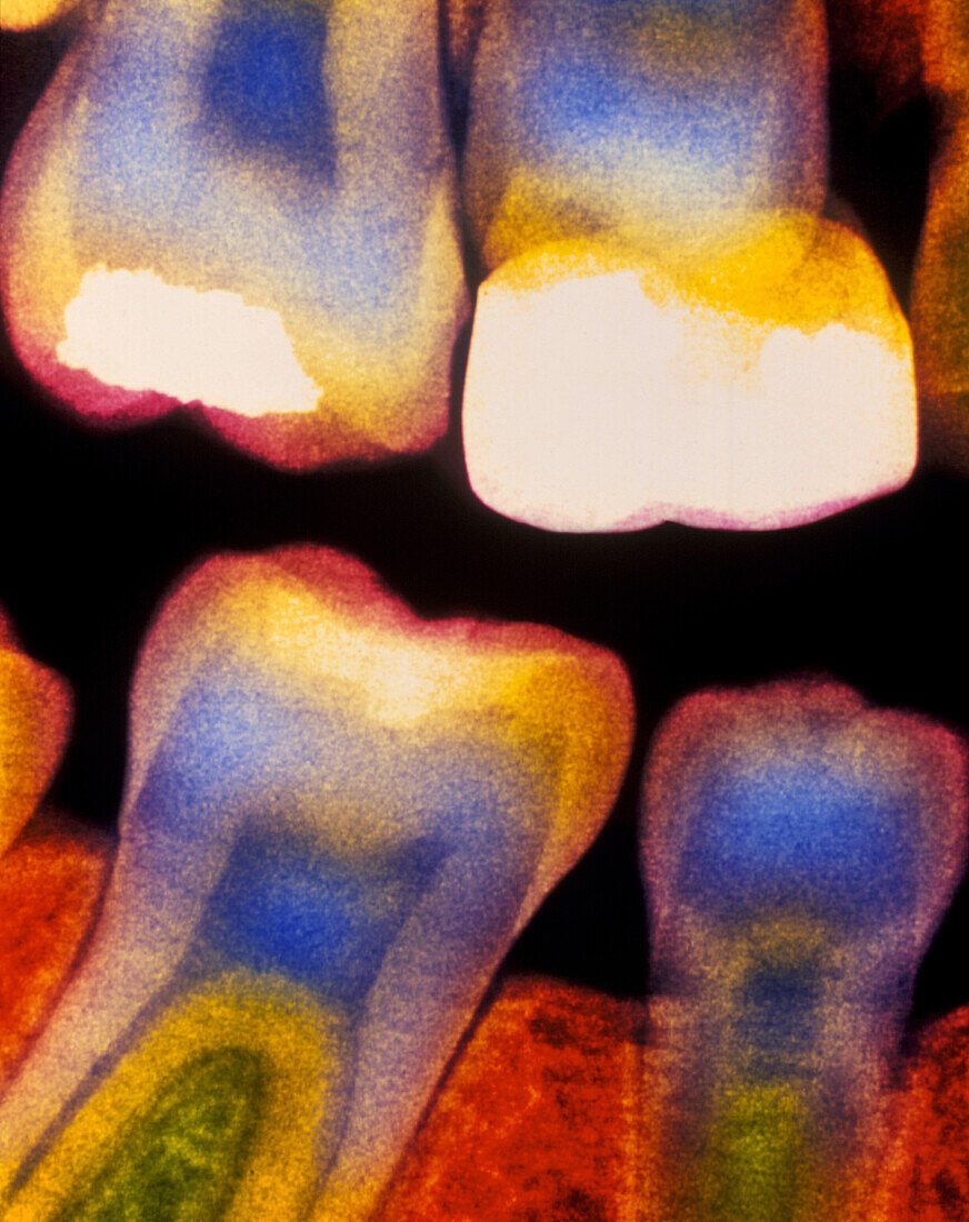 Colour X-ray of child's teeth with fillings/crown