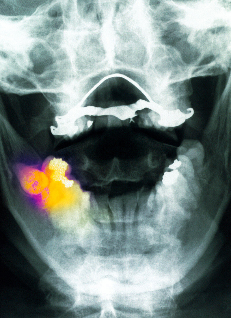 Coloured X-ray of impacted wisdom tooth and brace