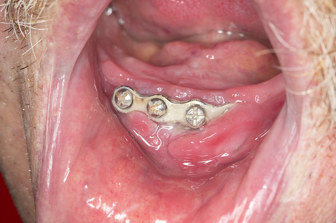 Jaw metalwork revealed by receding gums