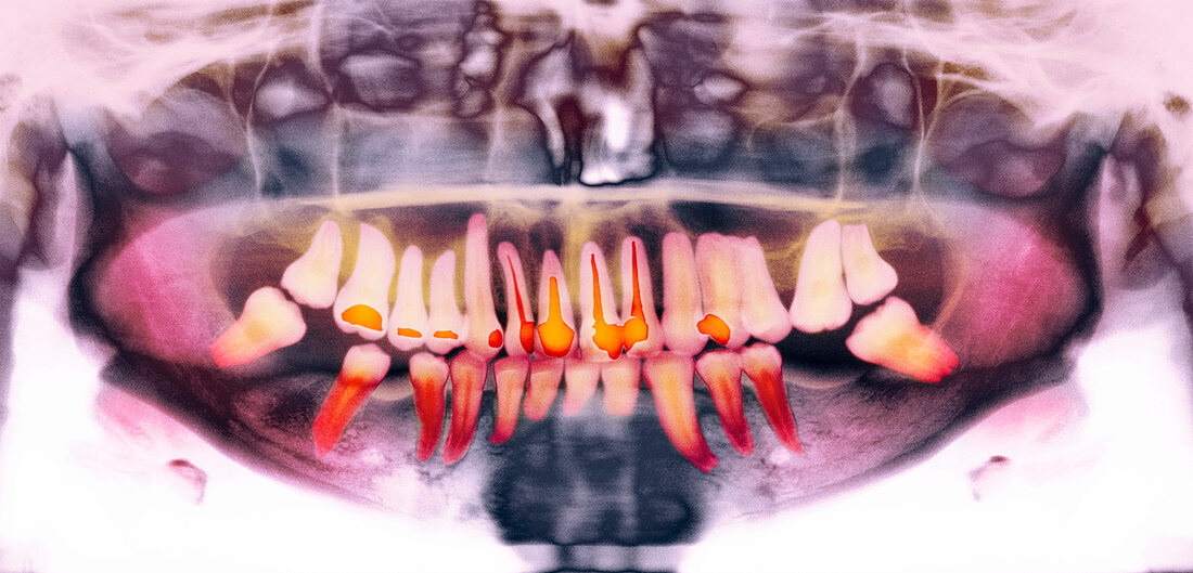 Root-canal treatment,dental X-ray