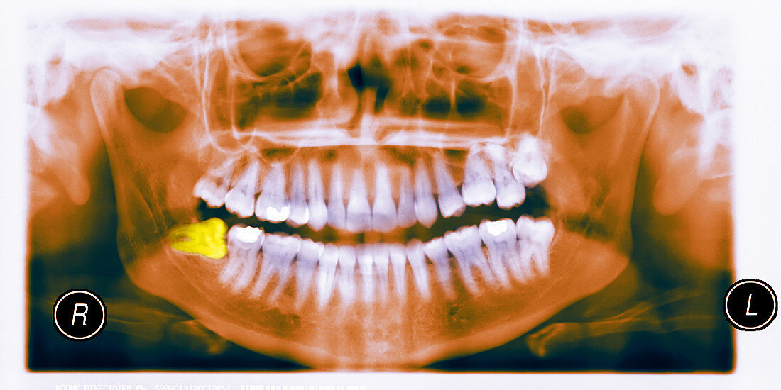 Abnormal wisdom tooth,X-ray