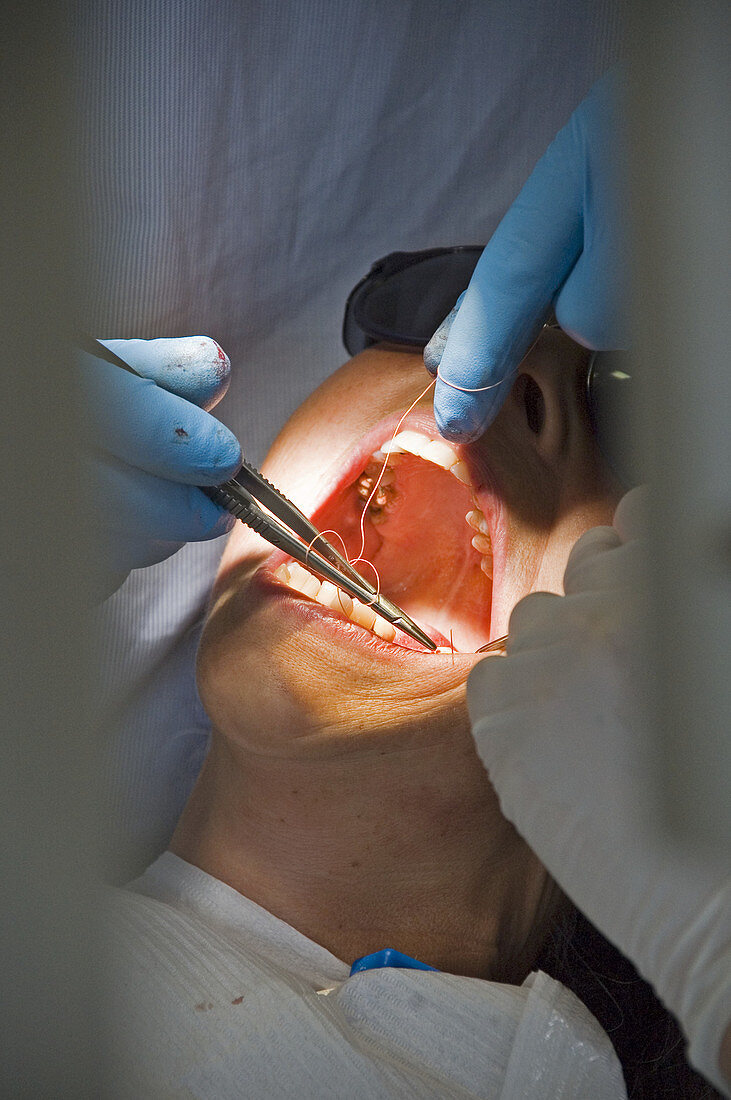 Dental stitching