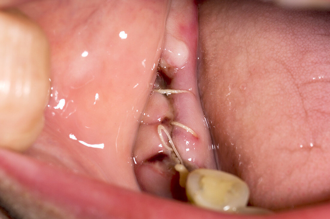 Gum after tooth extraction
