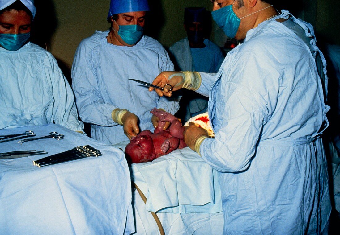 Caesarean birth: preparing to cut umbilical cord