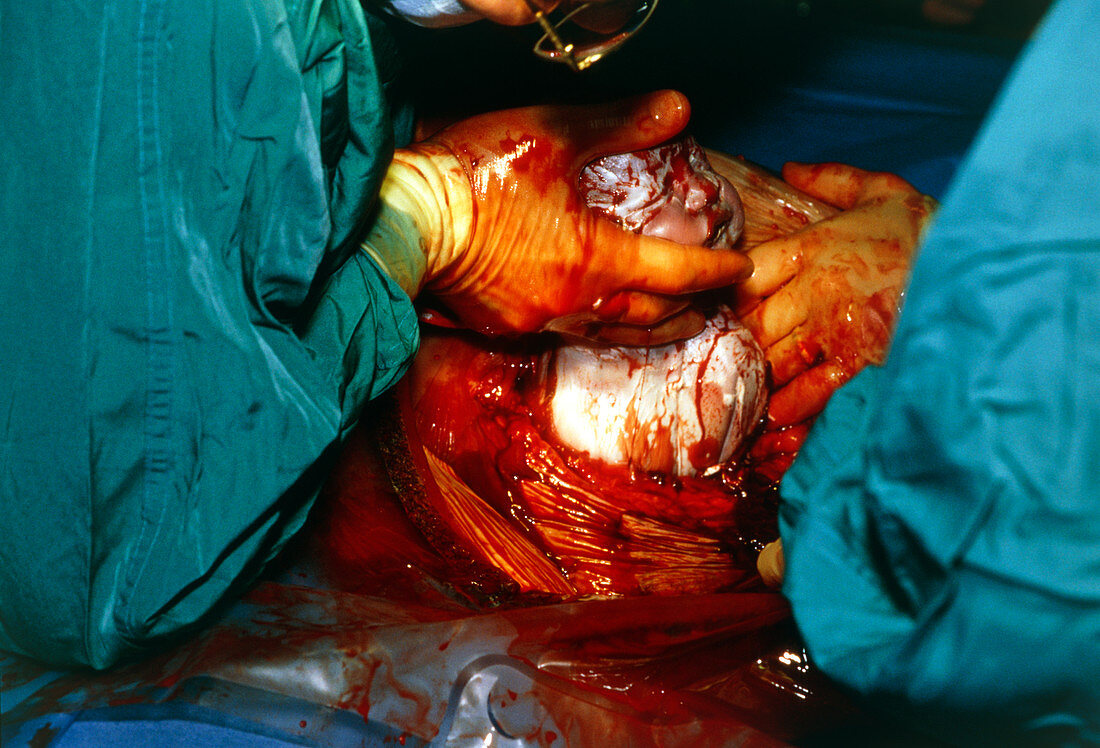 Surgeon removing baby in caesarean section birth
