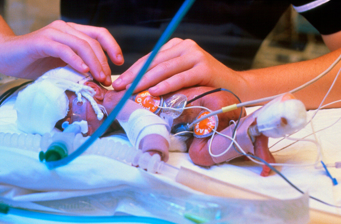 Premature infant with tubes and sensors