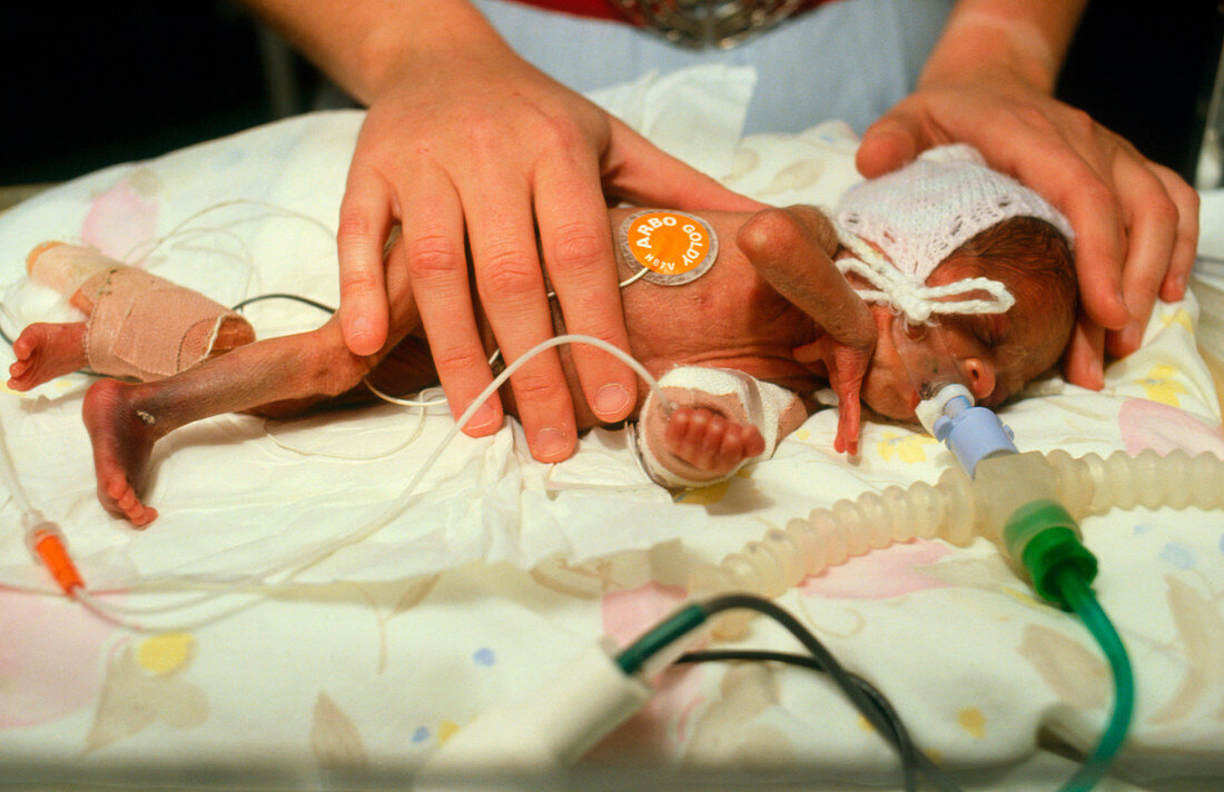 Premature baby girl in neonatal unit
