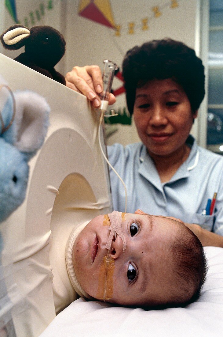 Premature baby in a miniature iron lung