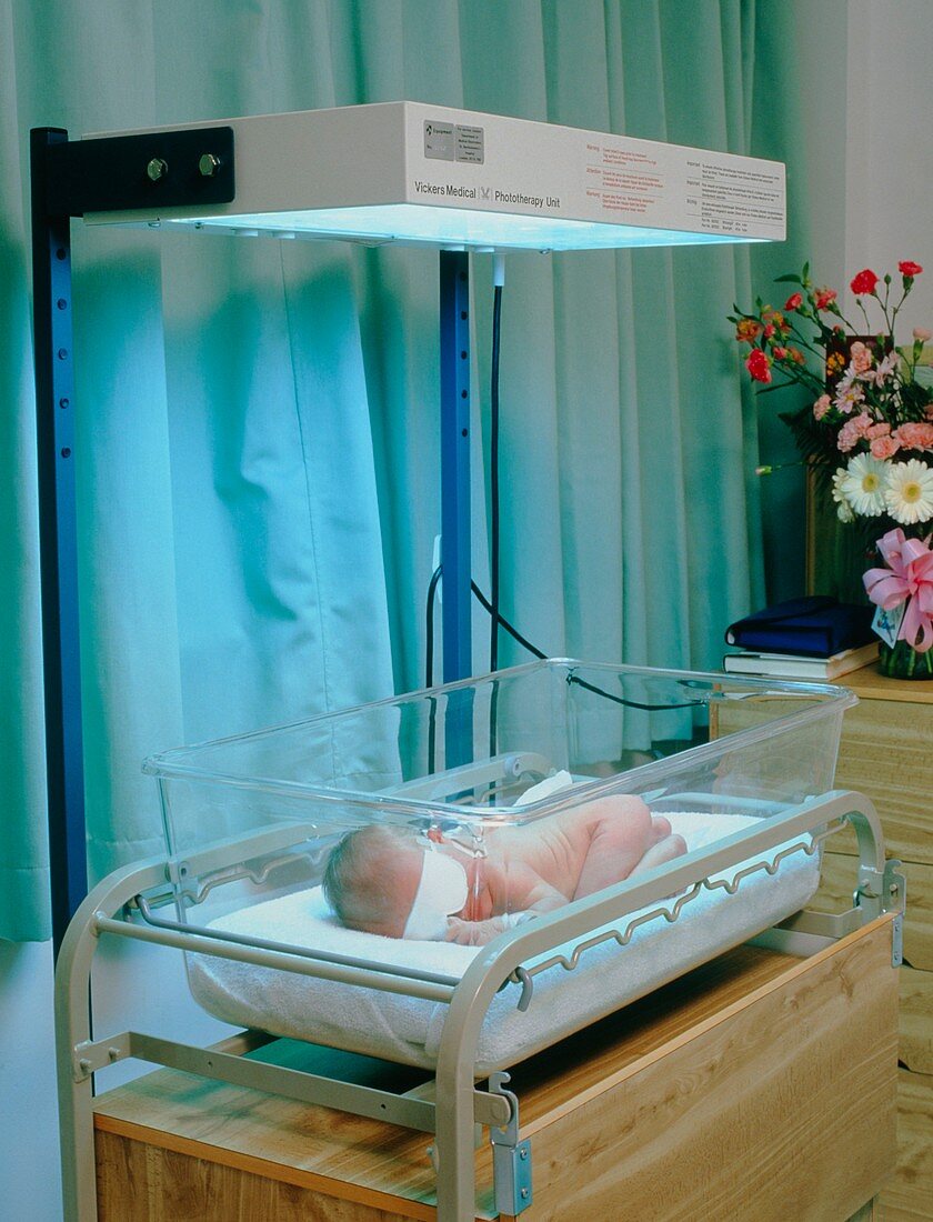 Baby affected by jaundice undergoing phototherapy