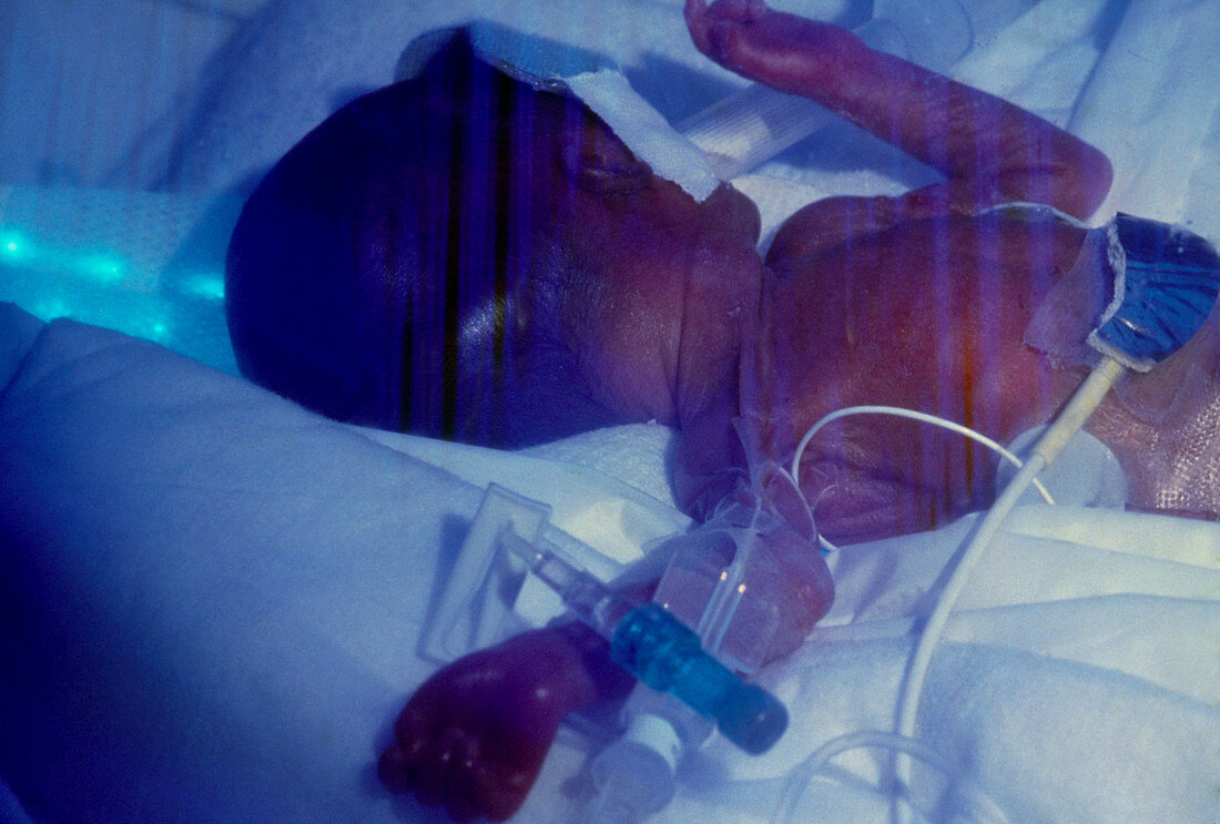 Premature baby (1.5 pounds) in intensive care