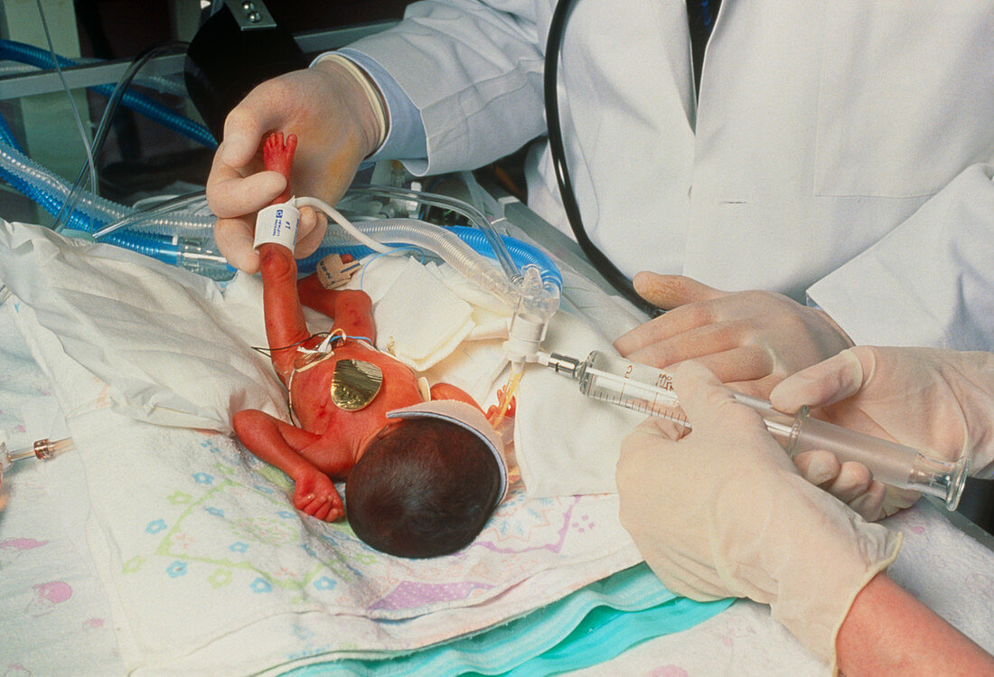 Premature baby receiving PFC liquid into its lungs